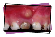 Abscess photo