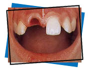 Avulsion photo 1