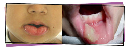 Bitten lip photo