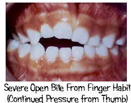 Open bite due to thumb sucking