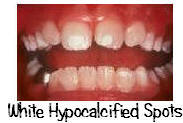 Hypocalcification of front teeth
