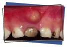 Color change resulting from abscess