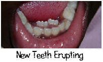 Ectopic eruption of new teeth