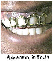 Dental grill