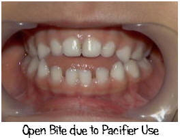 Open bite caused by pacifier habit
