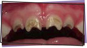 early childhood caries