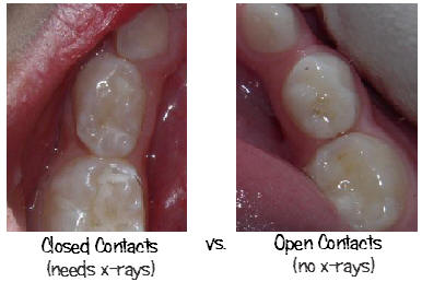 Dental x-ray open versus closed contact