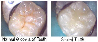 Dental Sealants protect teeth.