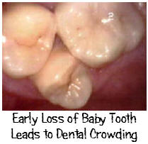 Dental Crowding