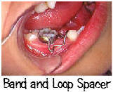 Band and Loop Spacer