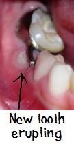 New tooth erupting under spacer.