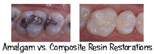 Comparison of white versus silver fillings