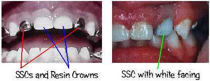 Dental crowns in front teeth