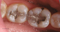 Changing a silver filling into a white filling